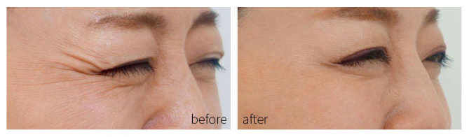 Hturi Lux™ Household facial mask photon acne rejuvenation instrument - Hturilux